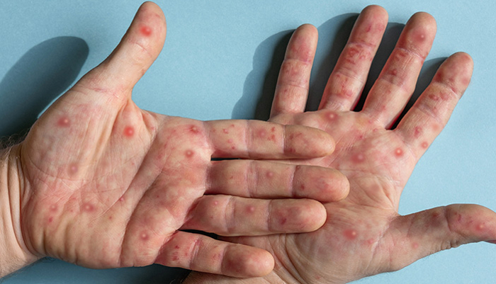 Tips Perlindungan dan Pencegahan Virus Monkeypox dari Dokter Ahli Allianz Life