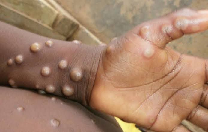 Dinkes DKI Siap Tangani Pasien Terjangkit Virus Mpox