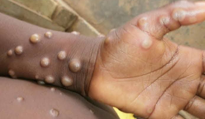 Dinkes DKI Klaim Puskesmas dan RSUD di Jakarta Siap Tangani Pasien Terjangkit Virus Mpox