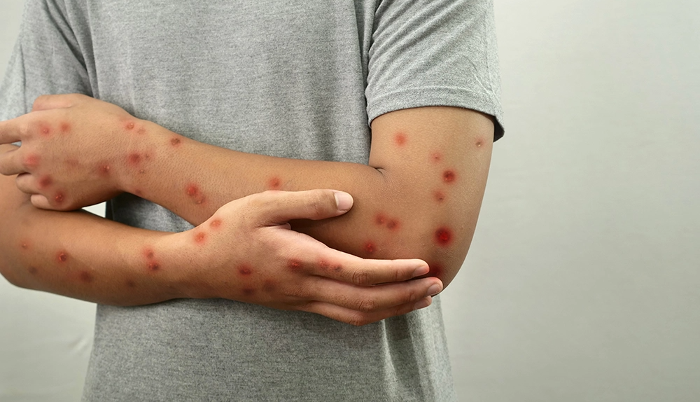 Pemprov DKI: Sasar Populasi Anak, BRIN Dorong Pemerintah Gerak Cepat Tangani Mpox